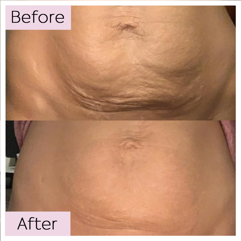 Anti-Cellulite Elixir