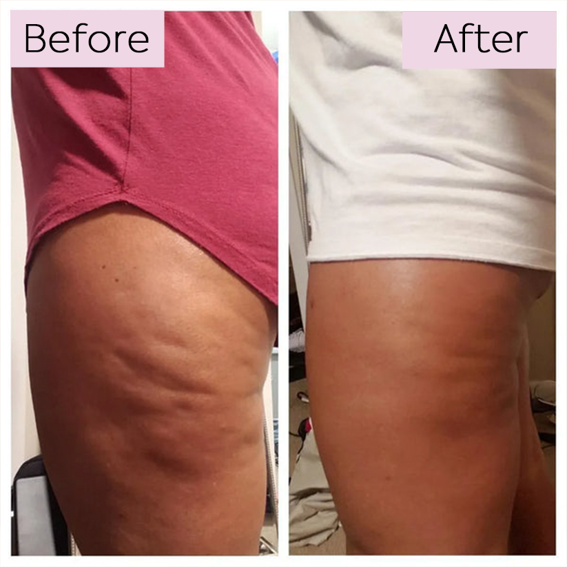Anti-Cellulite Elixir