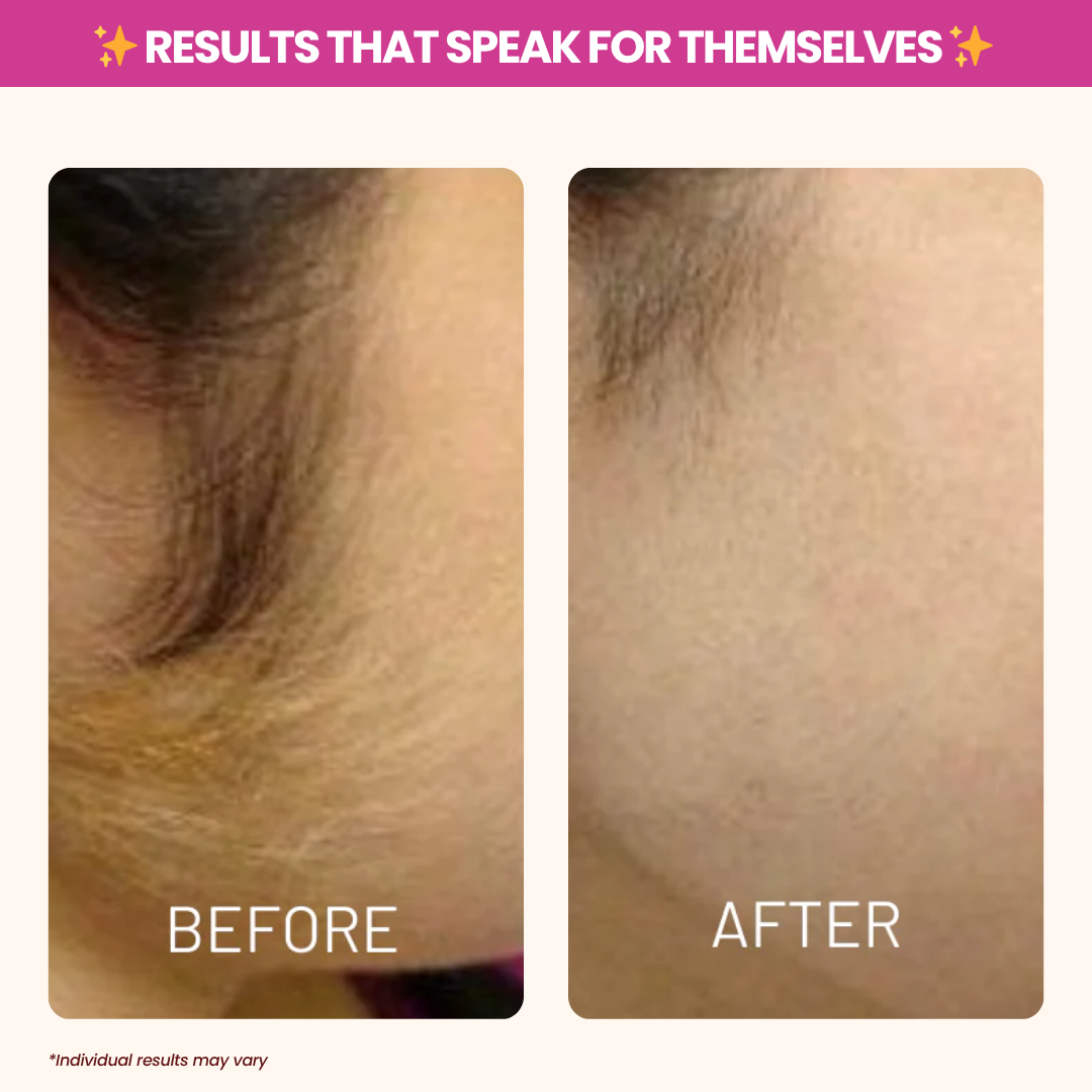 Cyperus Rotundus Oil for Hair Reduction